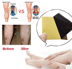 Varicose Veins Patch