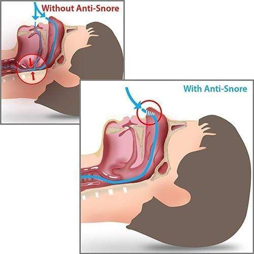 Snore Prevention Kit - 1 Kit Contain 8 PCS